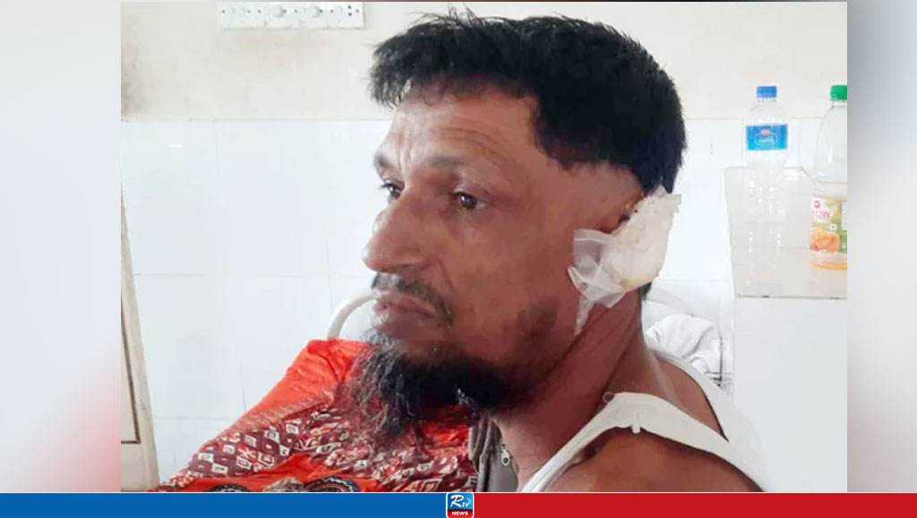 স্ত্রীর কামড়ে স্বামীর কান বিচ্ছিন্ন