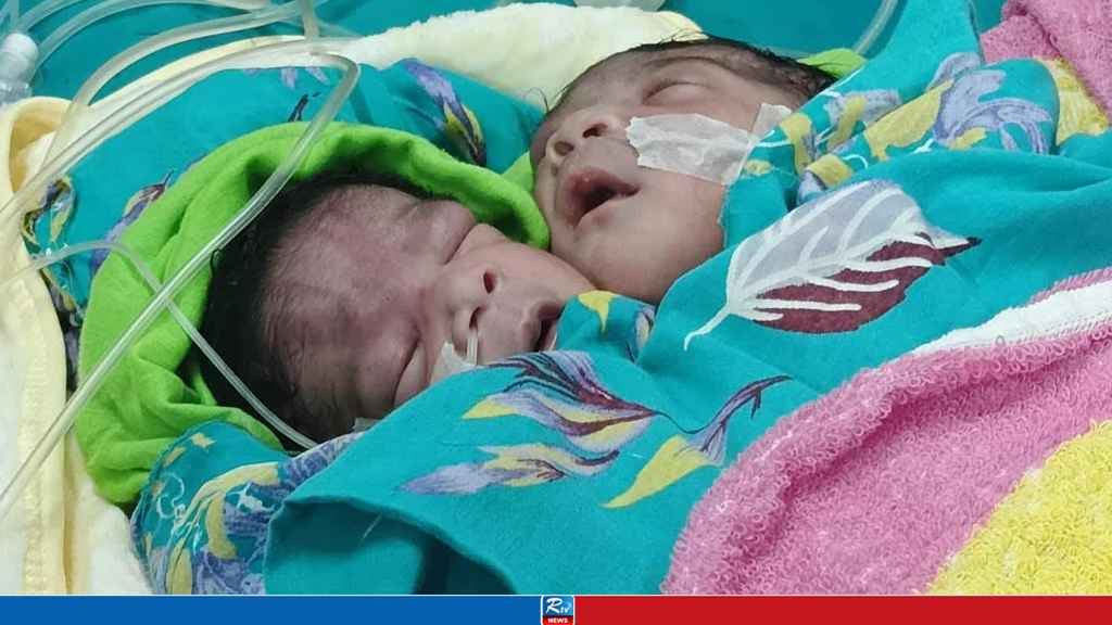 এক নবজাতকের দুই মাথা  